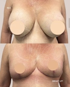 before-after photo breast-implants-with-breast-lift