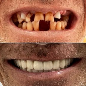 Before and after zirconia dental bridge results at Spanderashvili Dental Clinic, smile restoration