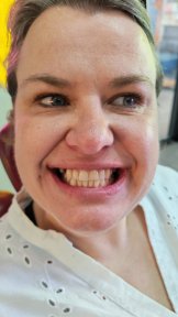 before-after photo all-on-6-dental-implants