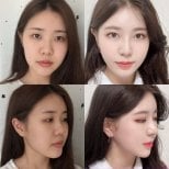 Before and after rhinoplasty results at VG Plastic Surgery, nose reshaping and facial harmony