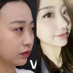 Before and after rhinoplasty results at VG Plastic Surgery, nose reshaping and profile improvement