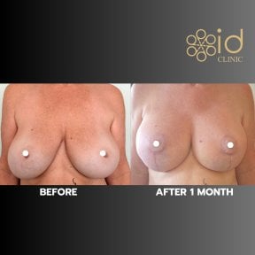 Before and after breast lift results at ID Clinic Bangkok, visible lift and contour improvement