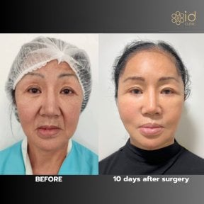 Результаты подтяжки лица до и после в ID Clinic Bangkok, омоложение через 10 дней