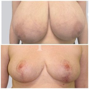 before-after photo mastopexy-breast-lift-contour-plastics