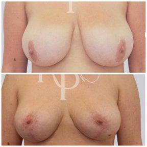 before-after photo mastopexy-breast-lift-contour-plastics