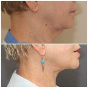 before-after photo tightening-of-facial-skin-facelift