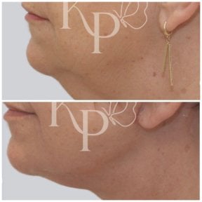 before-after photo tightening-of-facial-skin-facelift