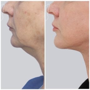 before-after photo tightening-of-facial-skin-facelift
