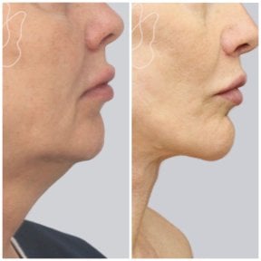 before-after photo tightening-of-facial-skin-facelift