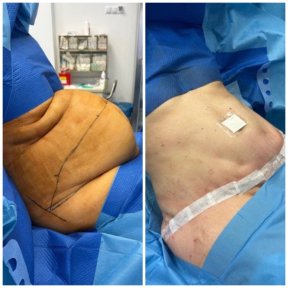 before-after photo abdominoplasty