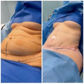 before-after photo abdominoplasty