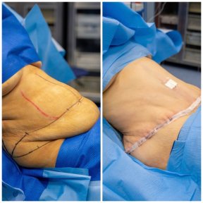 before-after photo abdominoplasty