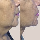 Resultados de lifting facial antes y después en Dr. Yazmin Sánchez Delgado, mejora de la mandíbula