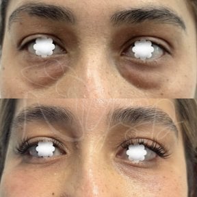 Blepharoplastik Vorher-Nachher-Ergebnis bei Dr. Yazmin Sánchez Delgado, Lidkorrektur