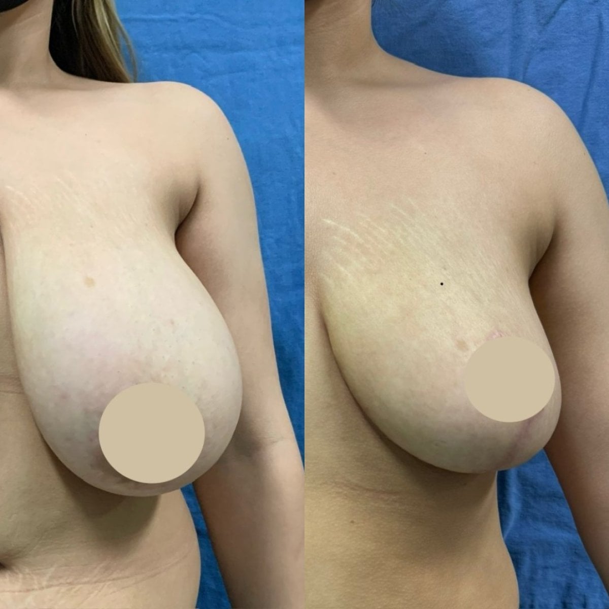 نتائج تصغير الثدي قبل وبعد في عيادة Dr. Yazmin Sánchez Delgado، شكل محسّن للثدي