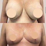 Resultados antes y después de implantes y levantamiento de senos en Dr. Yazmin Sánchez Delgado