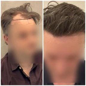 نتائج زراعة الشعر قبل وبعد في مركز Medeks – استعادة خط الشعر الطبيعي