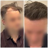 نتائج زراعة الشعر قبل وبعد في مركز Medeks – استعادة خط الشعر الطبيعي