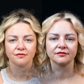 Resultados de blefaroplastia antes y después en Dr. Safa Manav Clinic, corrección de párpados