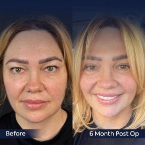 Resultados de blefaroplastia antes y después en Dr. Safa Manav Clinic, 6 meses postoperatorio