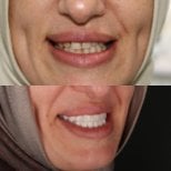 Résultats avant/après smile makeover – dents blanches et alignées après facettes dentaires