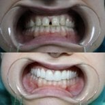 Résultats avant/après smile makeover – facettes dentaires pour dents alignées