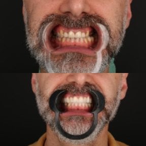 Résultats avant/après smile makeover – couleur et alignement des dents améliorés