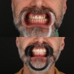 Résultats avant/après smile makeover – couleur et alignement des dents améliorés