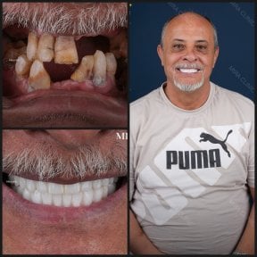 before-after photo all-on-6-dental-implants