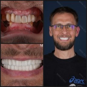 before-after photo all-on-6-dental-implants