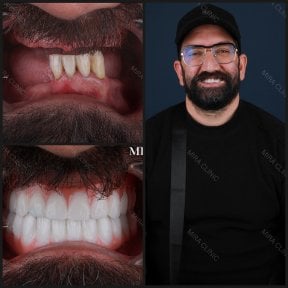 before-after photo all-on-6-dental-implants