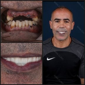 before-after photo all-on-6-dental-implants