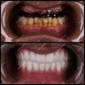 before-after photo dental-implant