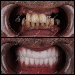 before-after photo dental-implant