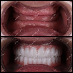 before-after photo dental-implant
