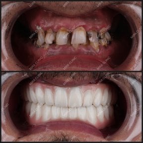 before-after photo all-on-4-dental-implants