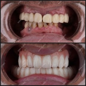 before-after photo all-on-4-dental-implants