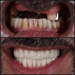 before-after photo all-on-4-dental-implants