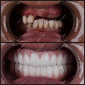 before-after photo all-on-4-dental-implants