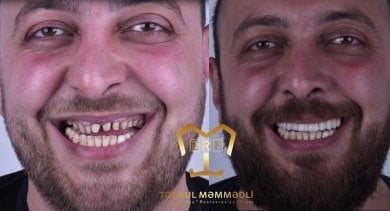 before-after photo dental-implant