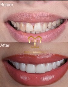 before-after photo dental-implant