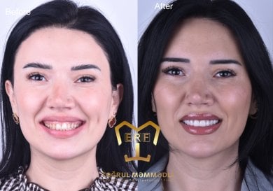 before-after photo dental-implant