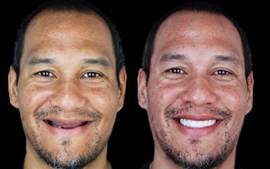 before-after photo dental-implant