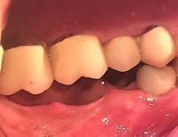 Dental implant result at SoftDentalCare Clinic, restored lower molar for improved chewing