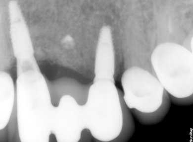 before-after photo dental-implant