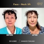 Before and after mini facelift and neck lift results at ID Clinic Bangkok, visible rejuvenation