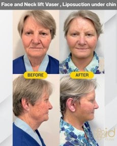 Before and after mini facelift and neck lift Vaser results at ID Clinic Bangkok, visible rejuvenation