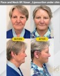 Before and after mini facelift and neck lift Vaser results at ID Clinic Bangkok, visible rejuvenation
