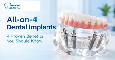 before-after photo all-on-4-dental-implants