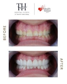 before-after photo zirconia-crown-installation
